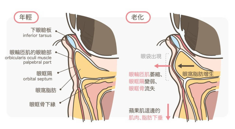 眼袋图片 示意图图片