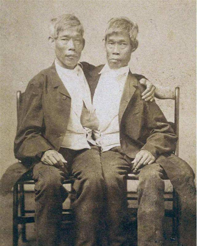 连体人会同时死亡吗?连体兄弟死后,健康的一方也在2小时后死亡