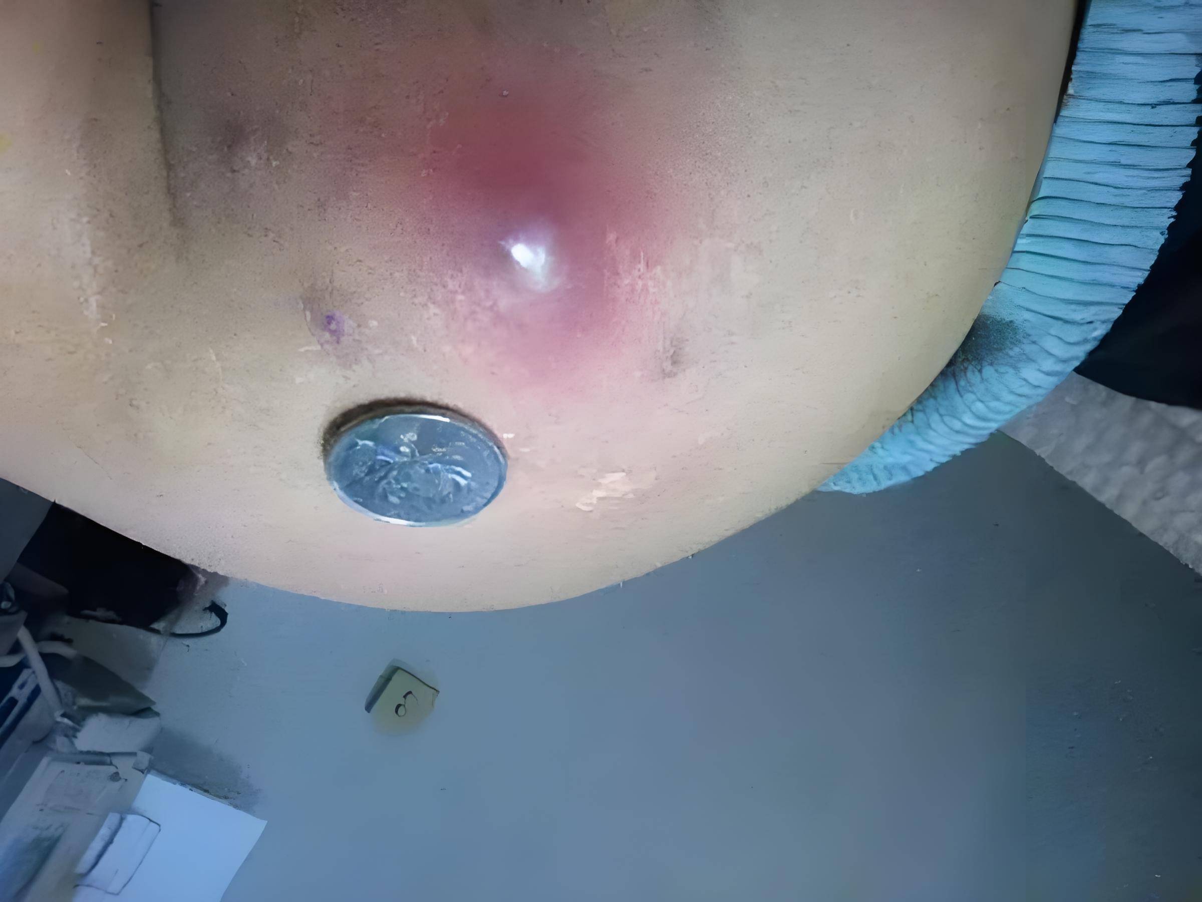 宿迁楚街医院专家来支招,告别臀部瘙痒烦恼