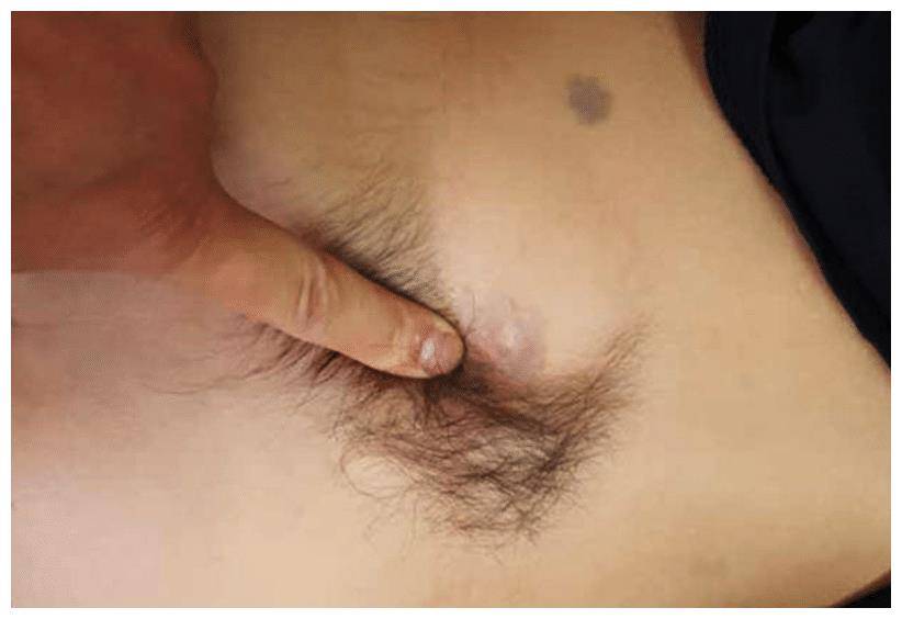 花季少女后背长毛发,不敢去公众场所怕被嘲笑,这是返祖现象吗_女孩