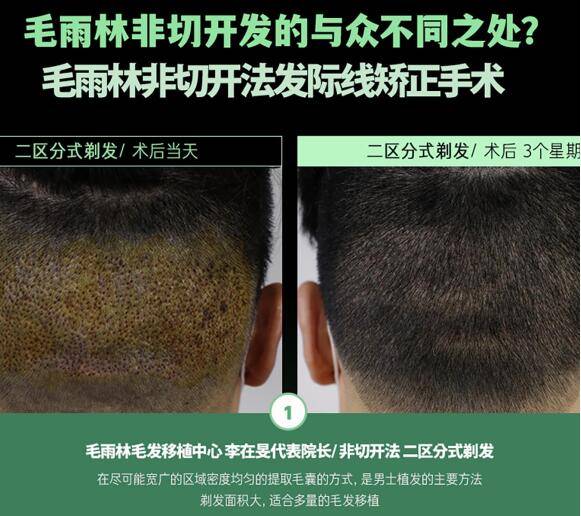 植发适合开车吗(植发的时候可以玩手机吗)