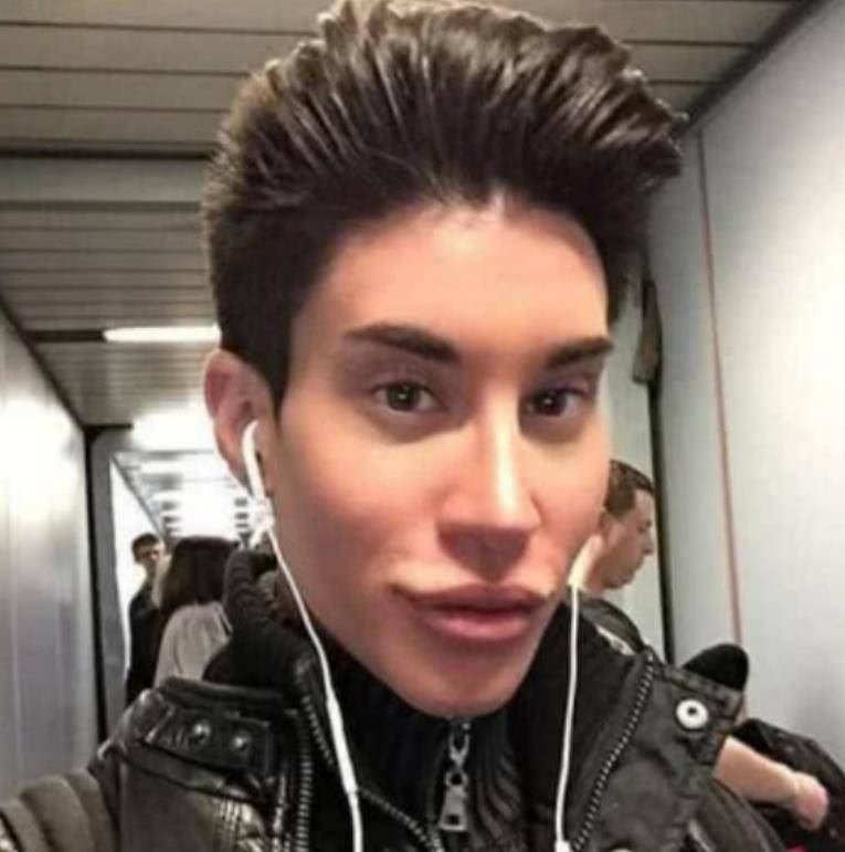 2013年,美国男子整容190次变芭比男友,曾花154万在后背植入翅膀