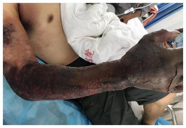 安徽一男子被剧毒五步蛇咬伤!有多毒?被咬了真的只能走五步吗?