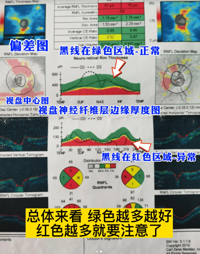oct主要用于检查视网膜各层组织的病变,如黄斑病变,视神经疾病,青光眼