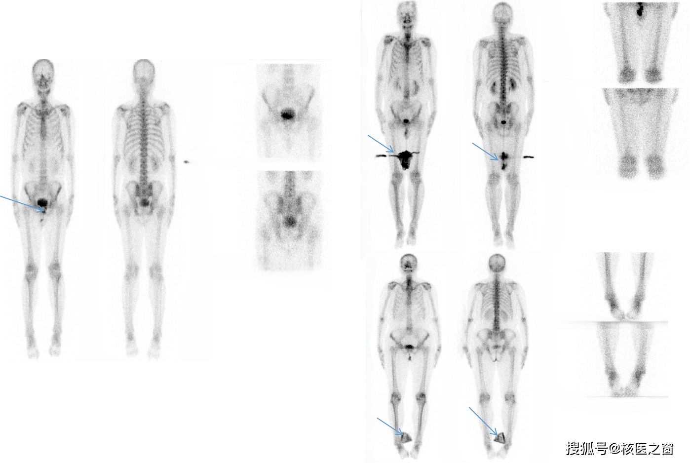 核医学全身骨显像检查