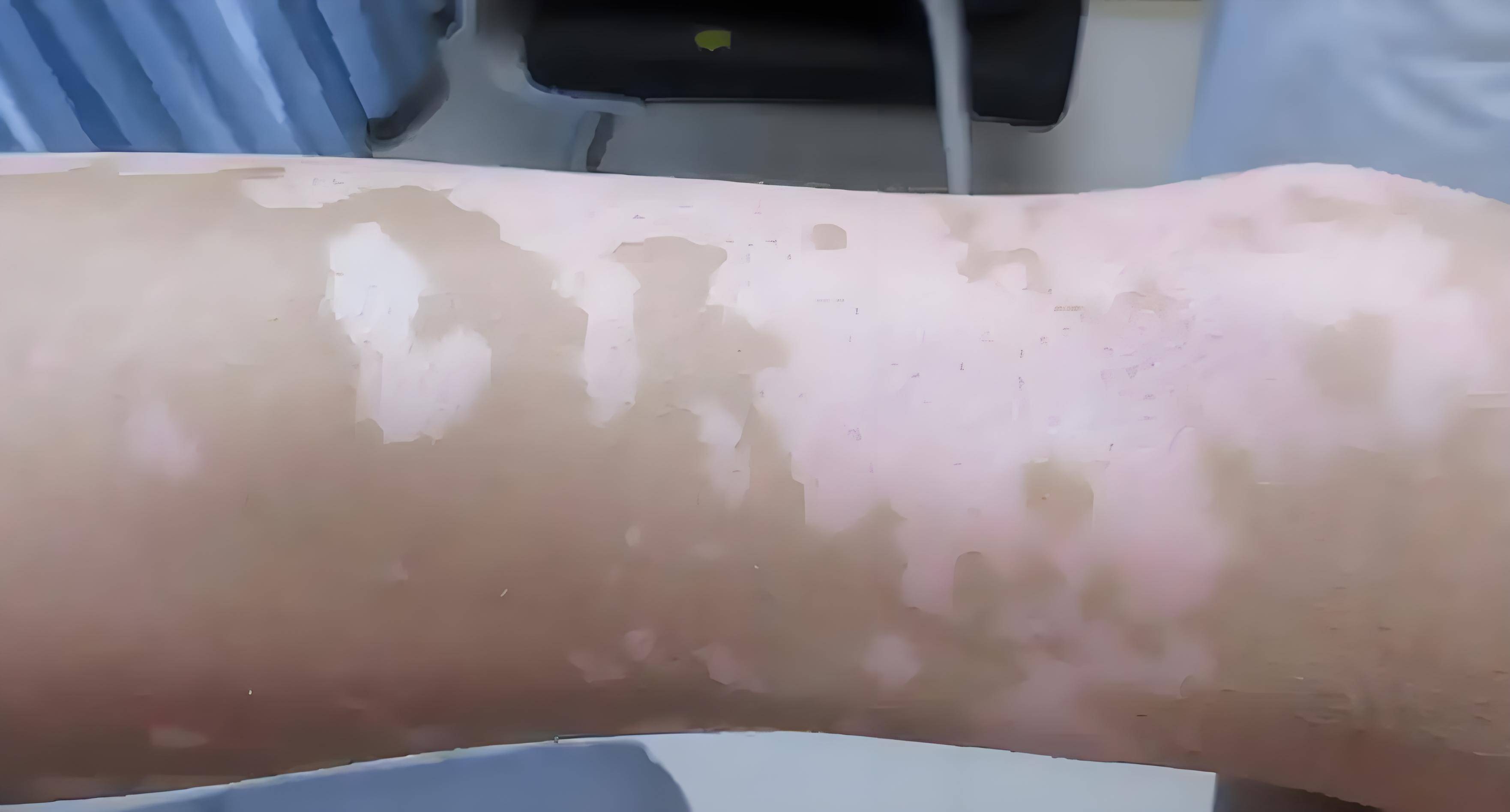 皮损部位还有残余大量色素时,白斑颜色会较正常皮肤浅淡,呈现淡白色