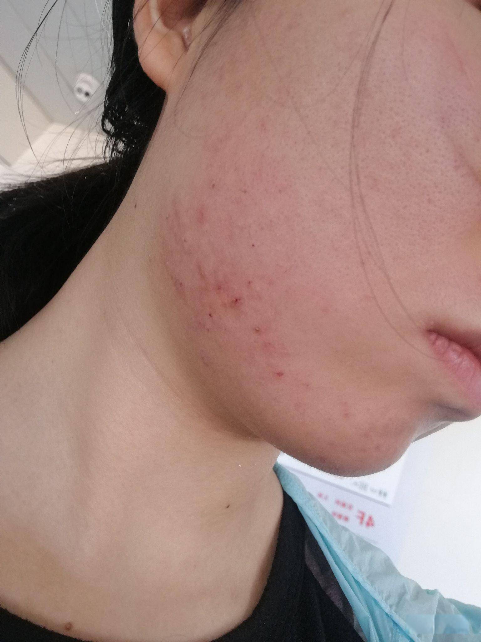 宿迁楚街皮肤病医院提醒:食物过敏需谨慎