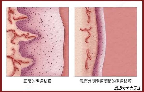 私密科普|长"皱纹"的阴道居然是年轻的标志?小分子肉芽肽!