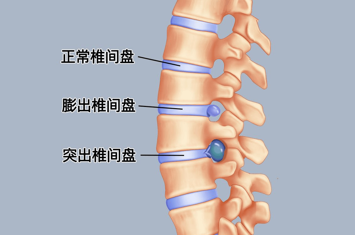 腰间盘突出:减轻腰椎压力的策略与方法