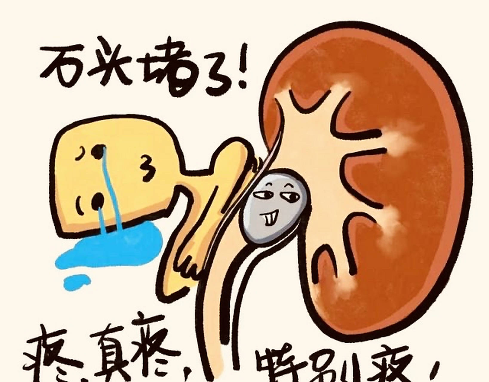 肾结石能否自然排出?何时需要手术?一文读懂关键判断标准