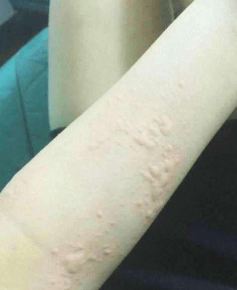 宠物美容师王芳患荨麻疹陷两难，治疗显效，后续抉择引深思