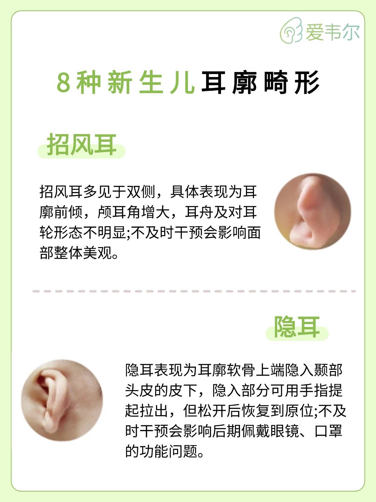 ️新生儿耳廓畸形会影响听力
