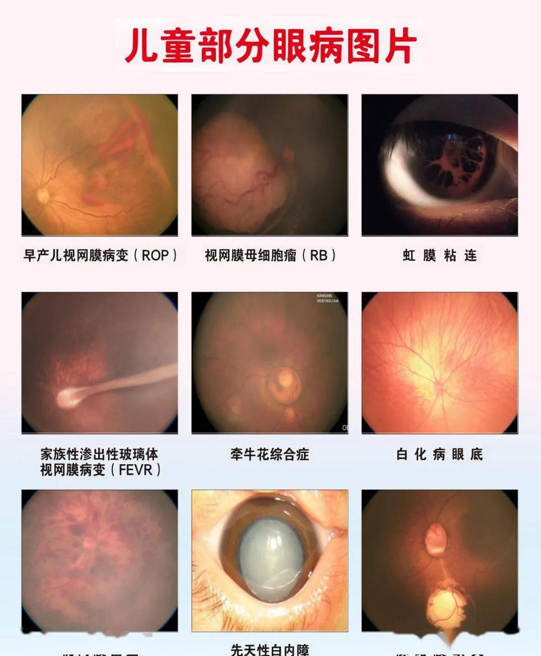 儿童严重眼病图片图片