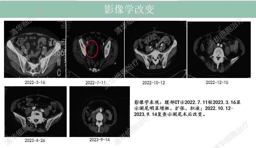 從肺癌術後腹腔轉移,到病情穩定無復發,她做了什麼?