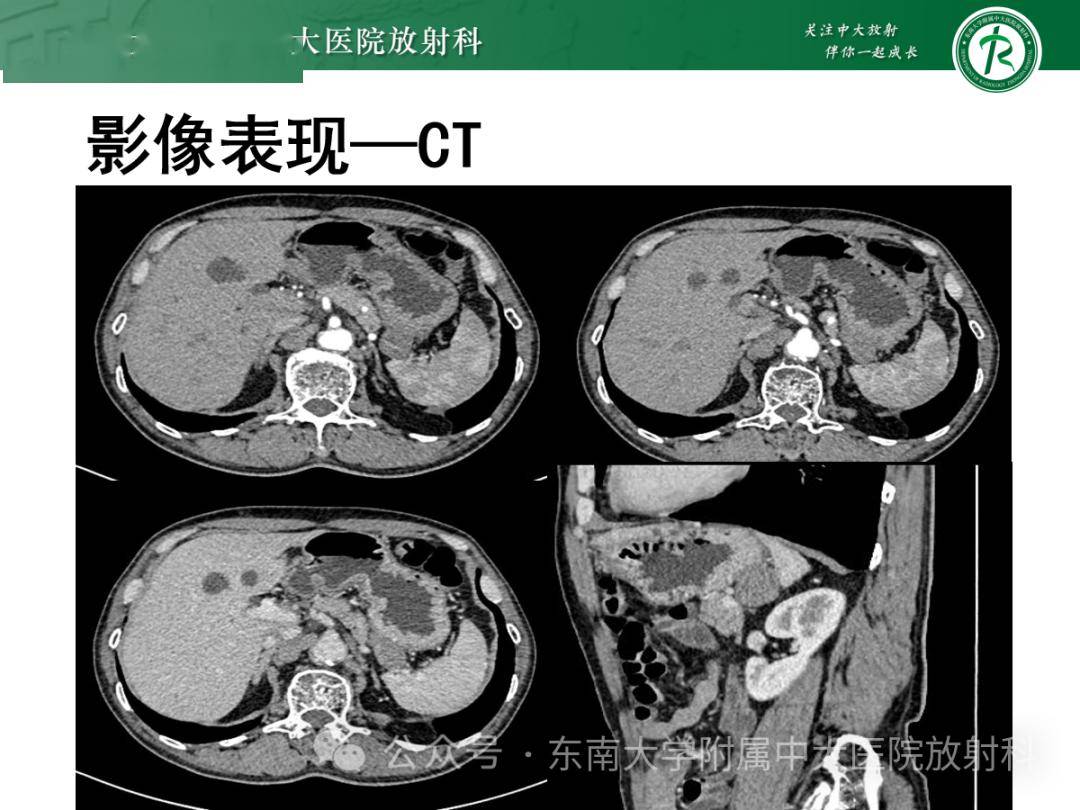 胃黏膜相關淋巴組織(malt)淋巴瘤_全網_影像_解剖圖