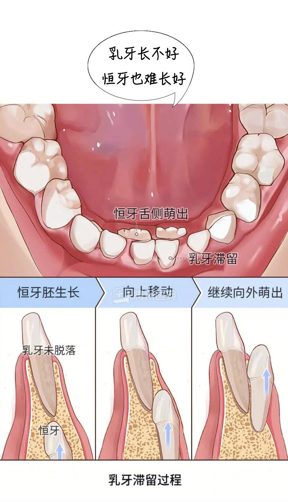 乳牙恒压图片