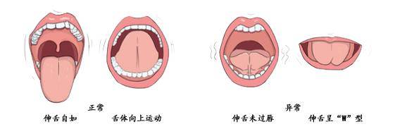 【健康科普】正确认识舌系带过短