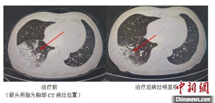 中新健康丨成都:患者反覆高燒咳嗽 竟因家裡養了一