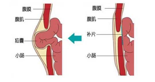 手术方式 腹股沟疝可分为开放手术和腹腔镜手术