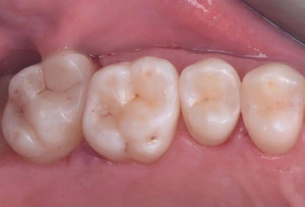 光固化垫底材料的使用时机和原因_ionosit_缝隙_牙齿