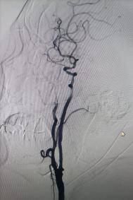 心瑋·藏經閣丨靈籠栓塞保護器下頸內動脈重度狹窄支架植入術一例
