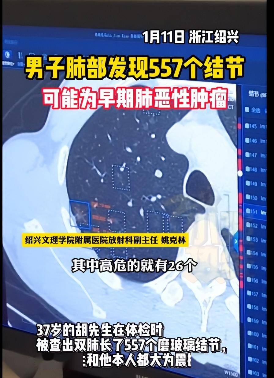 37岁男子肺部发现557个结节 出现肺结节的原因有哪些