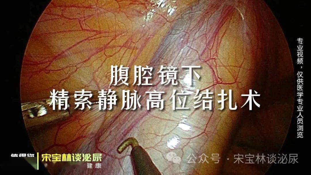 040腹腔镜下精索静脉高位结扎术(手术视频,非专业人士勿入)