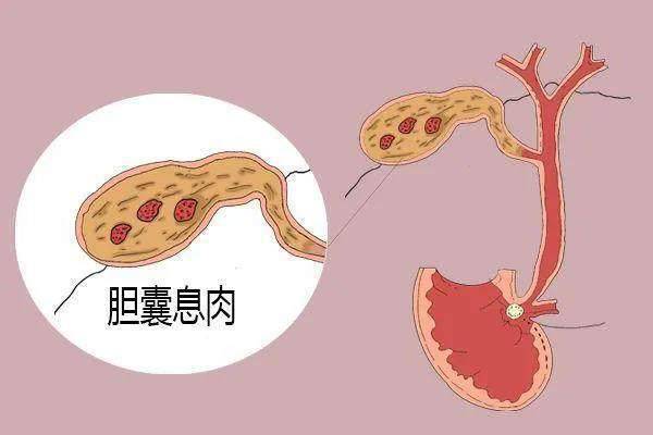 糖尿病患者有胆囊息肉,未达手术标准,中医辨证用药,散结不升糖_症状