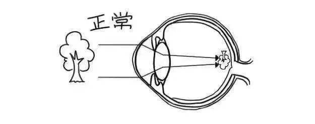 這3種情況比近視更可怕,晚了不可逆!_儲備_孩子_散光