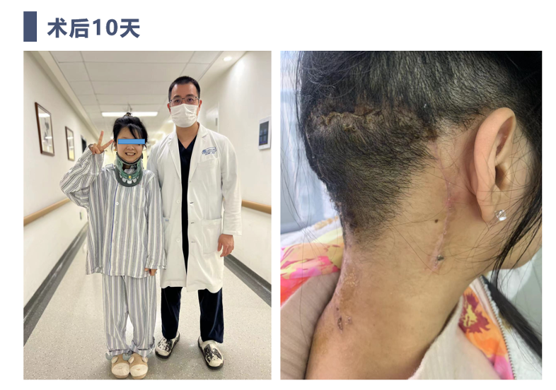 外侧入路颅颈交界脊索瘤切除 颈椎四棒系统固定重建术_手术_肿瘤_患者