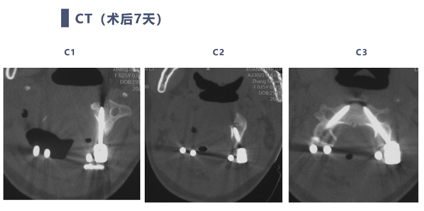 宣武有術|後路聯合極外側入路顱頸交界脊索瘤切除