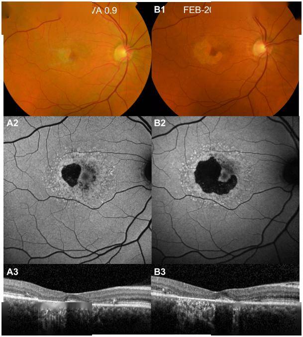 警惕!勿将晚发型1型stargardt病误诊为amd