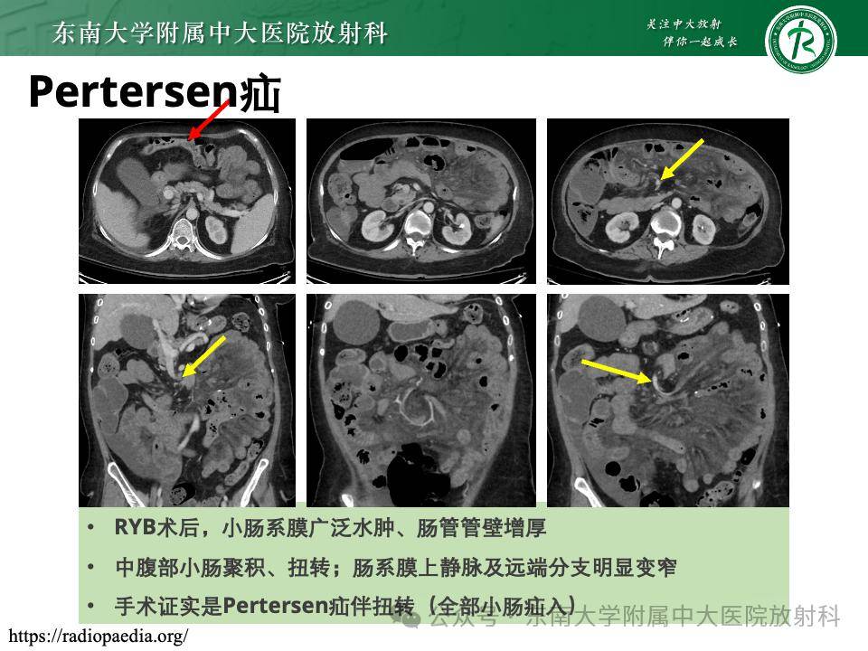 腹內疝的影像診斷_全網_解剖圖_系統