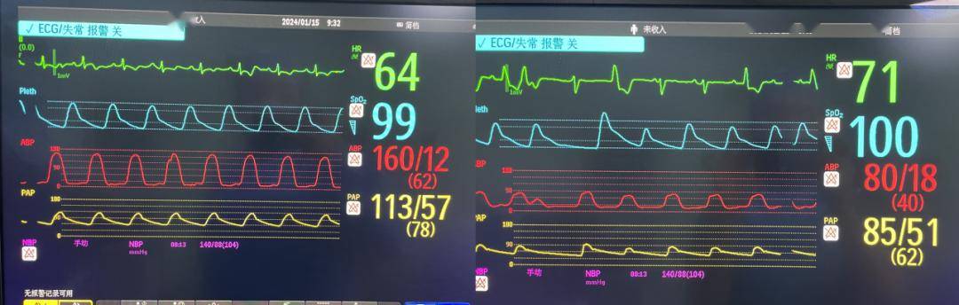 哈醫大二院病例精析:tavr術中患者突發胸痛,冠脈血流