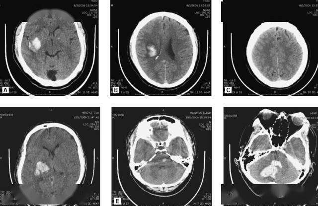 基底节区大量高血压性脑出血,破入脑室及蛛网膜下腔,周围水肿,脑干