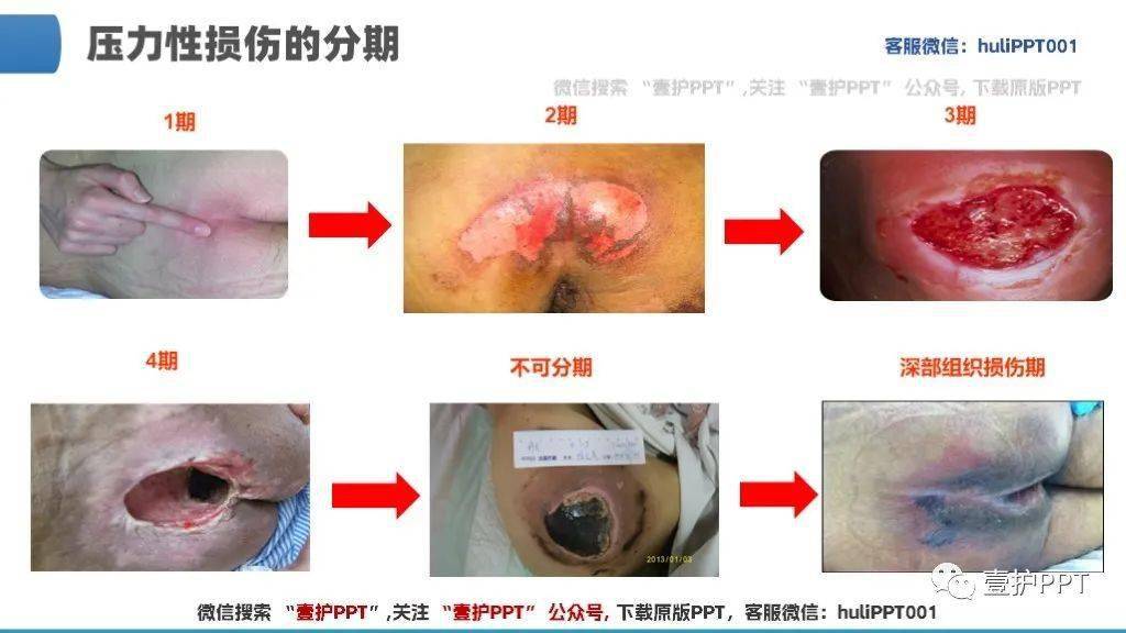 【ppt】压力性损伤伤口处理_直播_护理_来源