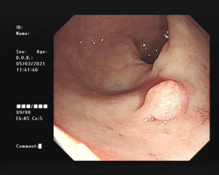 肠息肉检查报告图片