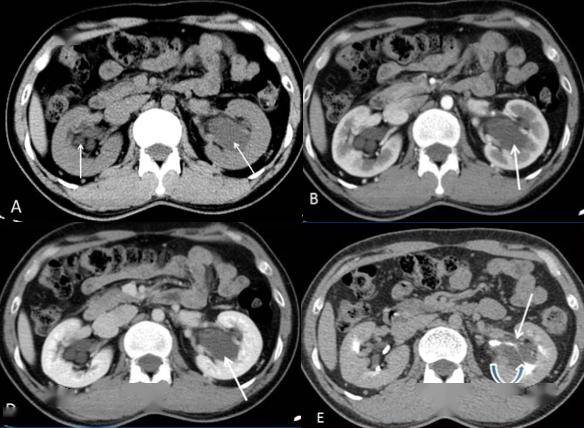 ct 秒杀:肾脏病变快速鉴别_课程_影像_腹膜
