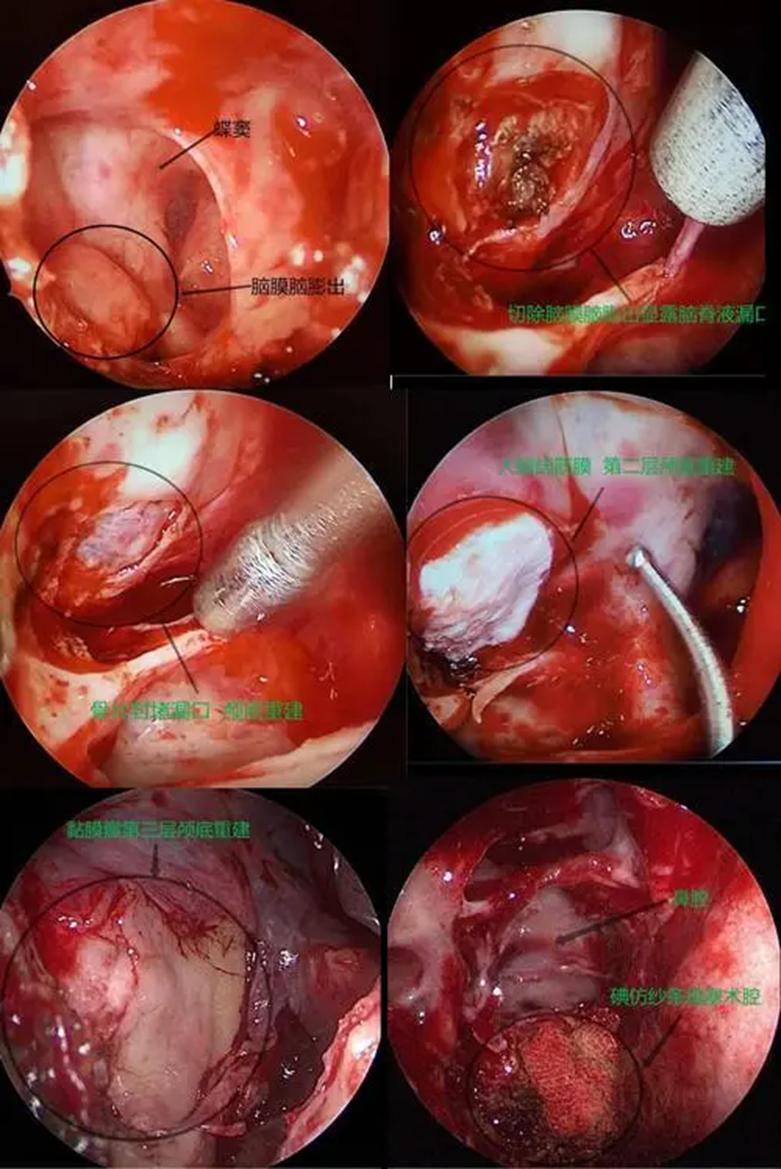 鼻窦炎内窥镜手术图片