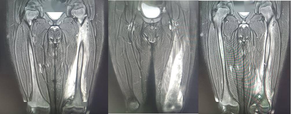 左側股骨mri示左側股骨周圍肌肉軟組織內多發異常信號;左側骨內側肌
