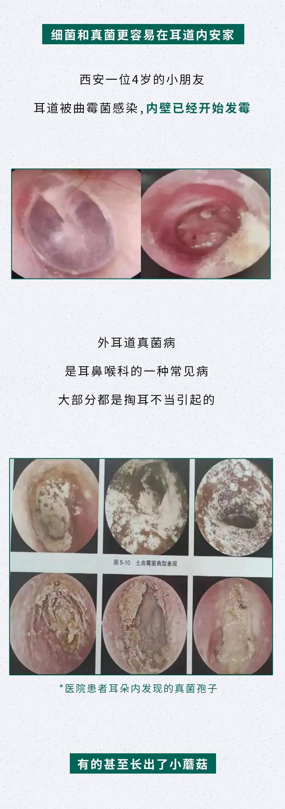 还tm掏耳屎呢?看看你的耳朵都烂成啥样了!