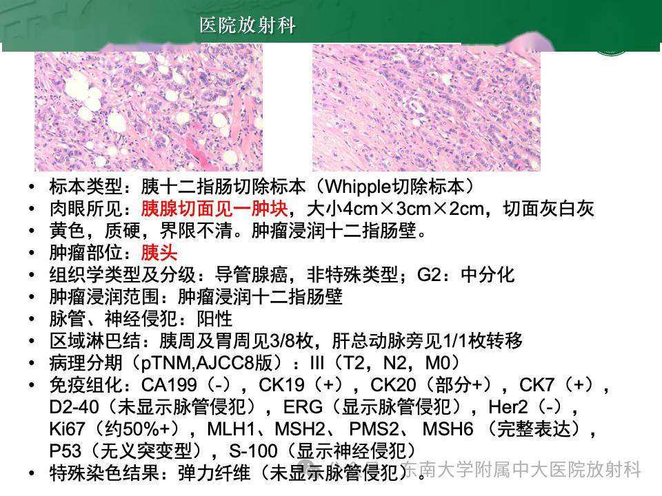 vater壺腹癌影像診斷_全網_解剖圖_納差