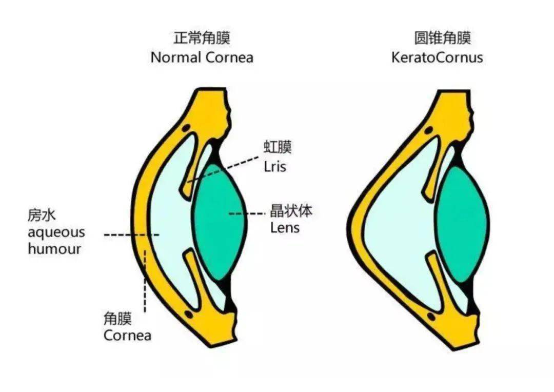 圆锥角膜怎么治?