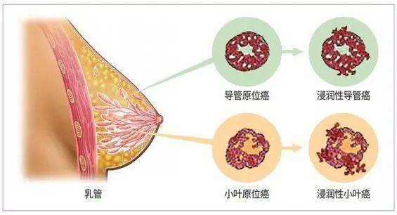 80后奶奶患上乳腺癌