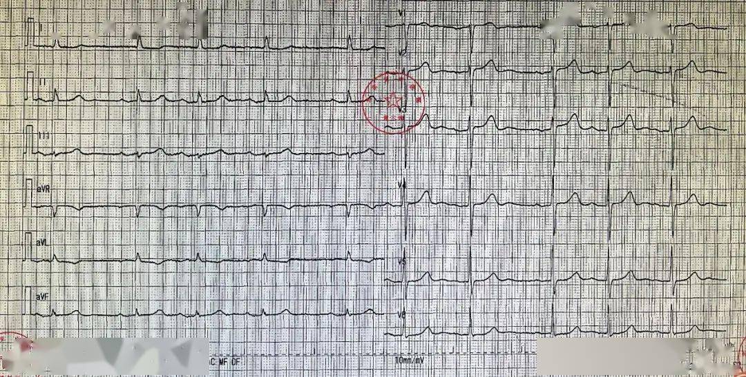 典型s1q3t3心电图图片