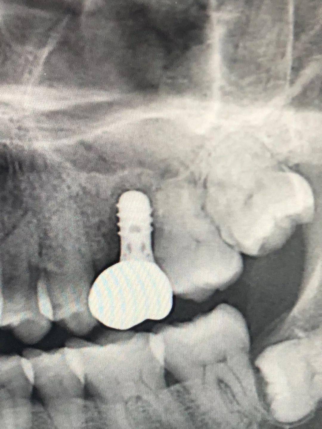【病例分享】吸烟与种植体周围炎-从一例种植体拔除病例_患者_影响