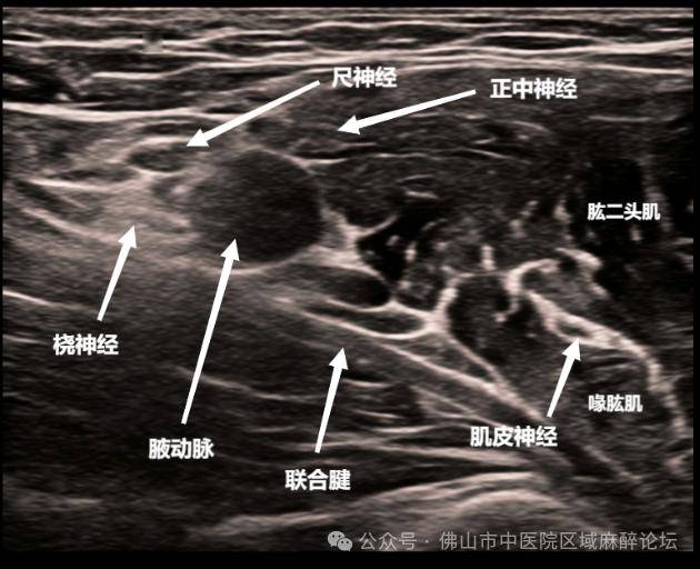 上肢血管超声解剖图图片