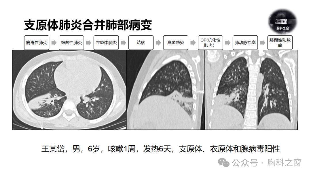 多為1,2個葉段,主要以實質病變為主,間質受累較輕;大葉性肺炎多見於中