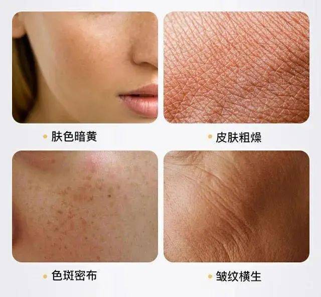 3,肌肉及韧带层:面部出现整体下垂,轮廓不清晰,脸型变成长方