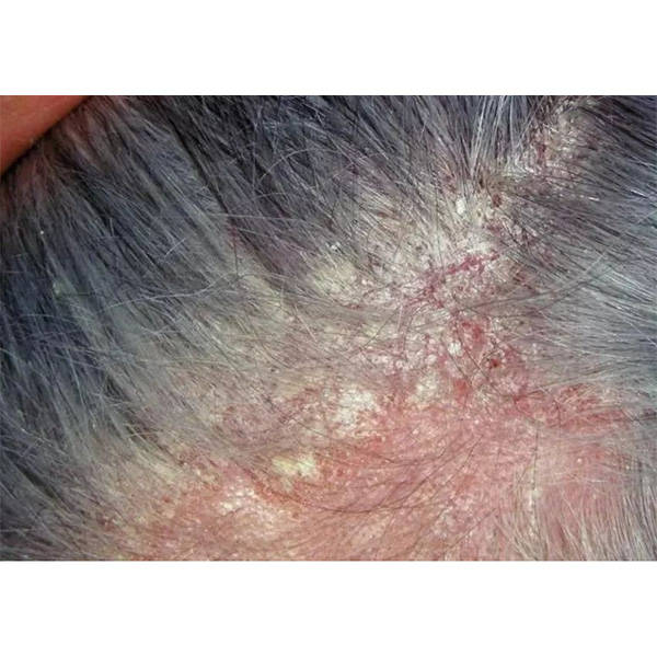 马拉色菌毛囊炎禁忌图片